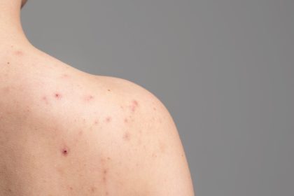 How to get rid of shoulder acne: 5 home remedies worth a try