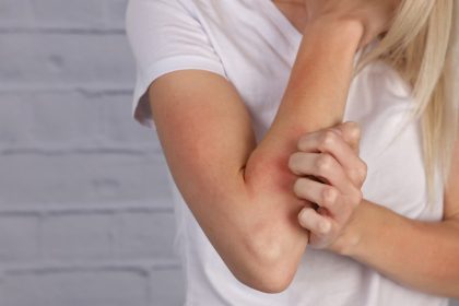 Eczema: 5 effective home remedies worth trying!