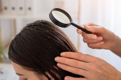 Home remedies for dandruff: Try eggs and yoghurt to soothe itchy scalp